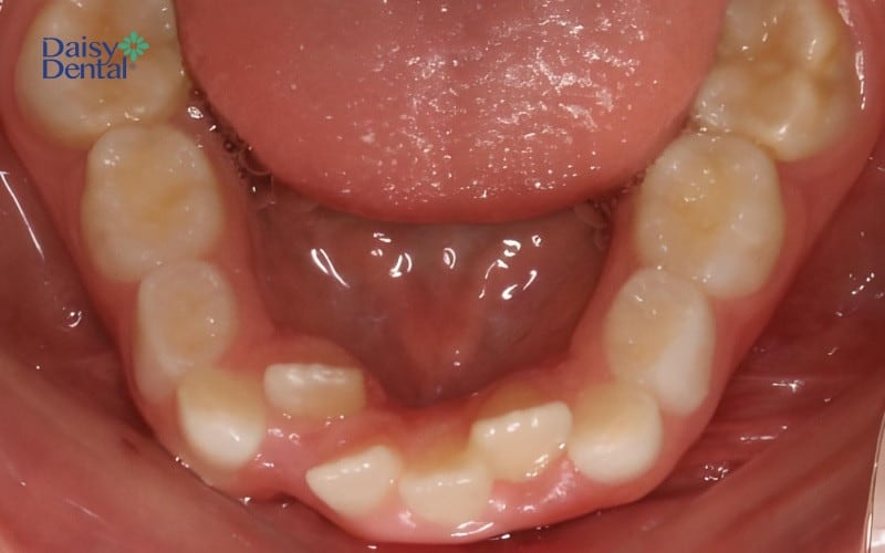 Răng mọc không đều có thể là do di truyền từ người thân