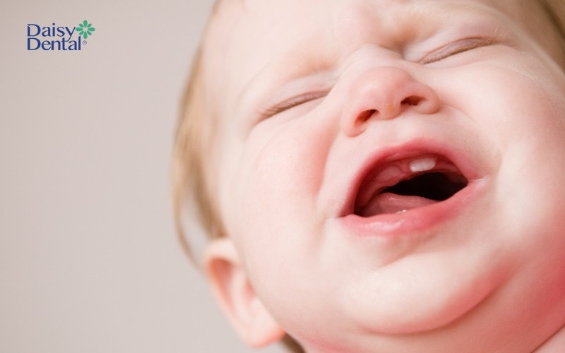 Răng mọc không đúng thứ tự sẽ ảnh hưởng đến quá trình phát âm, dễ khiến bé nói ngọng
