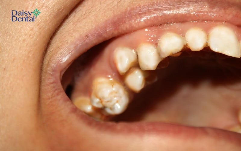 Răng mọc trên lợi gây ra bệnh lý răng miệng