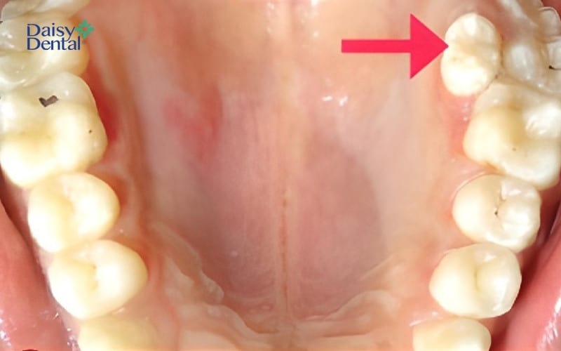 Răng số 9 là chiếc răng mọc thừa, thường mọc gần nhóm răng hàm lớn