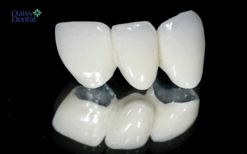 Răng sứ Venus là chất liệu răng toàn sứ, có màu sắc thẩm mỹ trắng sáng, tự nhiên như thật