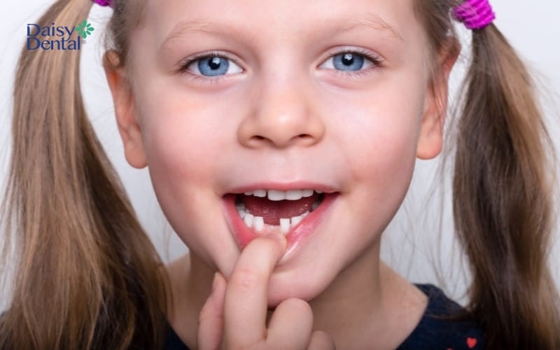 Răng sữa có vai trò định hướng hướng mọc của răng vĩnh viễn