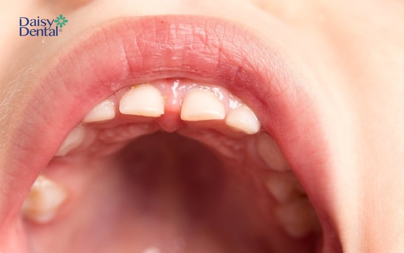 Răng sữa của bé có kích thước nhỏ hơn nhiều so với răng vĩnh viễn