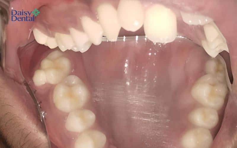 Răng thừa xuất hiện trên cung hàm thường được nha sĩ chỉ định nhổ bỏ