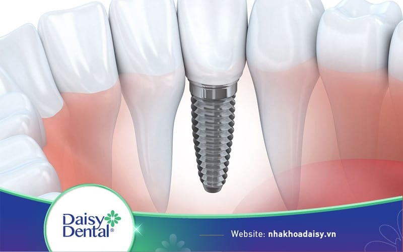 Cấy ghép implant có an toàn không
