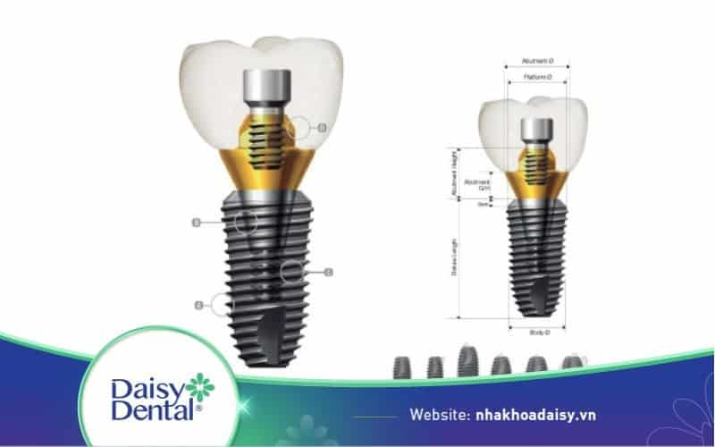 implant dentium mỹ