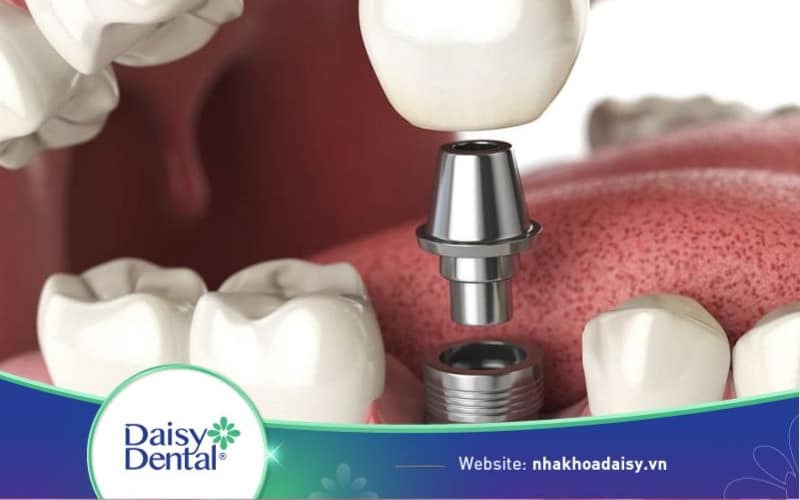 Nhổ răng bao lâu thì cấy Implant