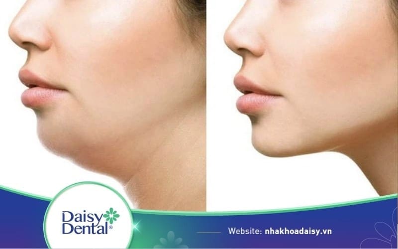tập mewing có cải thiện mặt lệch