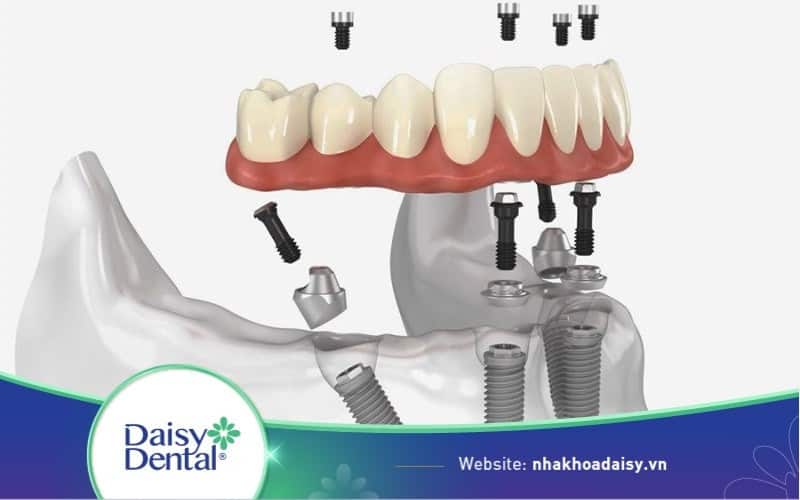 trồng răng bằng cấy ghép implant có thật sự tốt