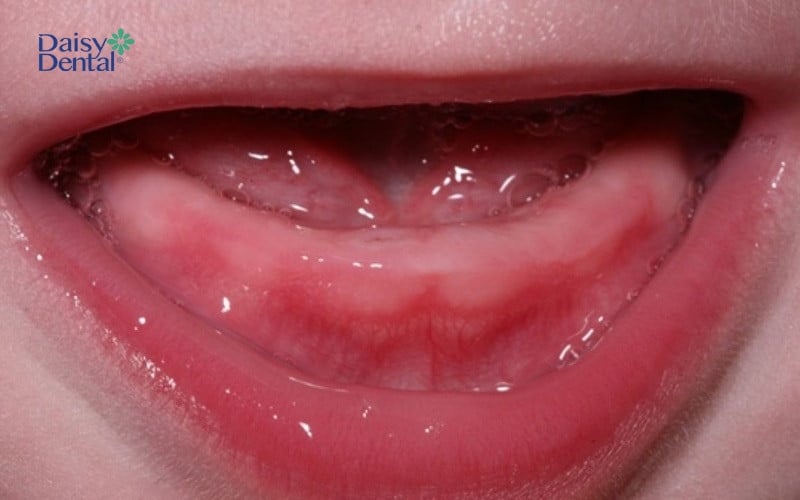Trẻ chậm mọc răng là khi đã hơn 1 tuổi nhưng chưa có chiếc răng sữa nào