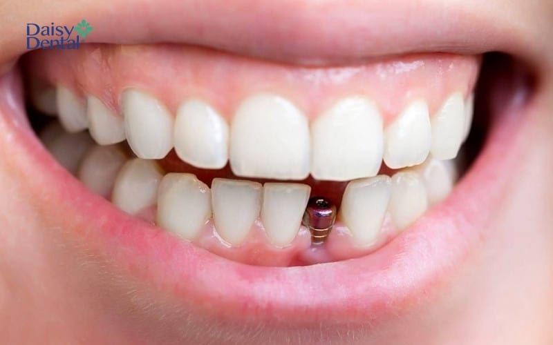 Trồng răng Implant tức thì phù hợp với một vài đối tượng nhất định