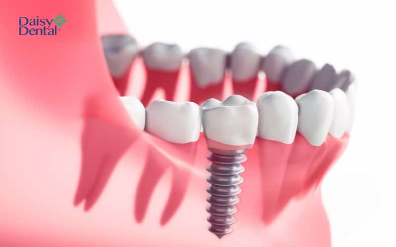 Trồng trụ Implant Dentium Mỹ giúp ngăn chặn tiêu xương hàm