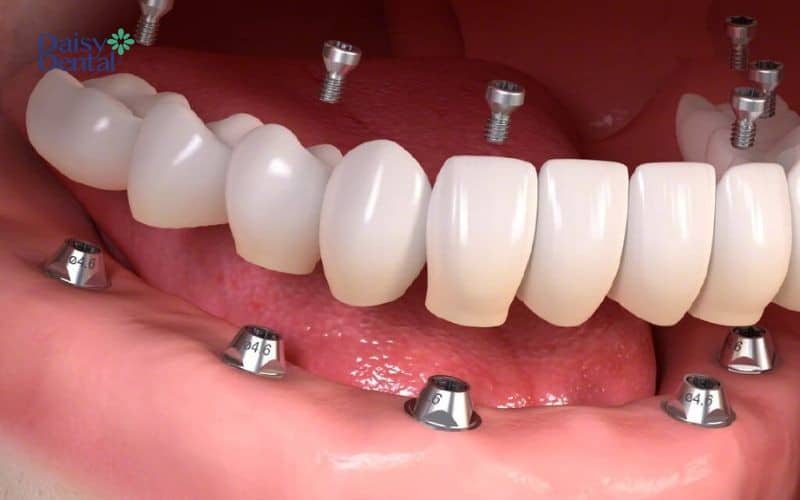 Trụ Implant Nobel được sử dụng trong mọi trường hợp mất răng