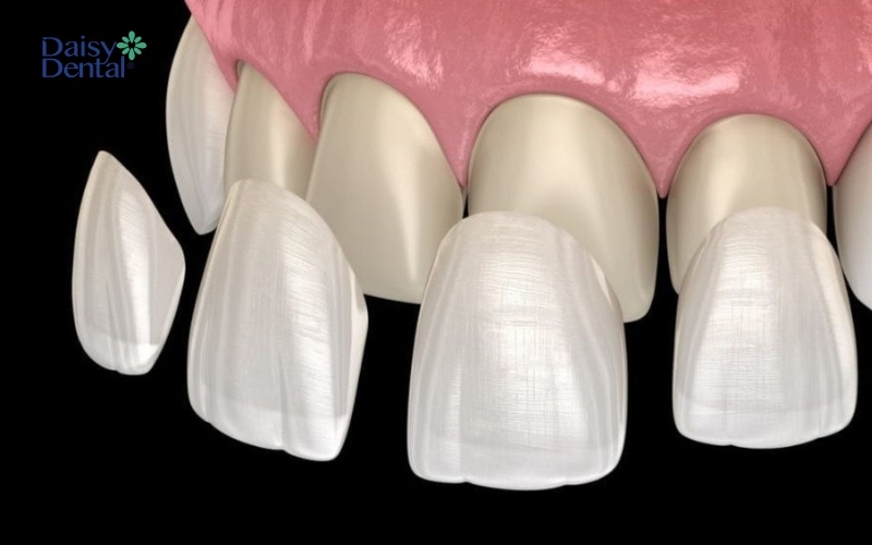 Có một sự thật về dán sứ bạn nên biết là kỹ thuật này không cần mài răng quá nhiều