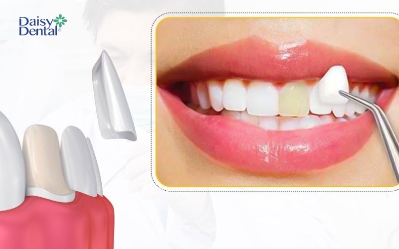 Dán răng sứ có thể bảo tồn tối đa mô răng thật