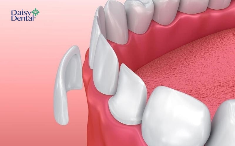 Dán răng sứ không gây hại nếu được thực hiện đúng kỹ thuật