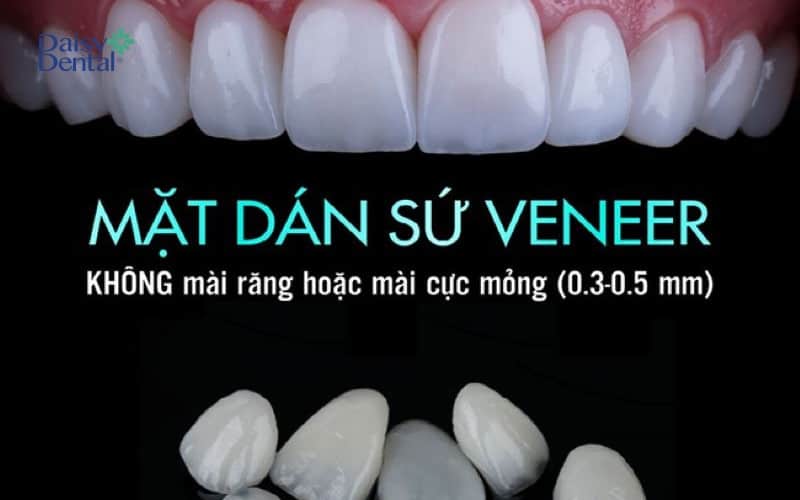 Dán răng sứ Veneer Emax được đông đảo khách hàng ưa chuộng