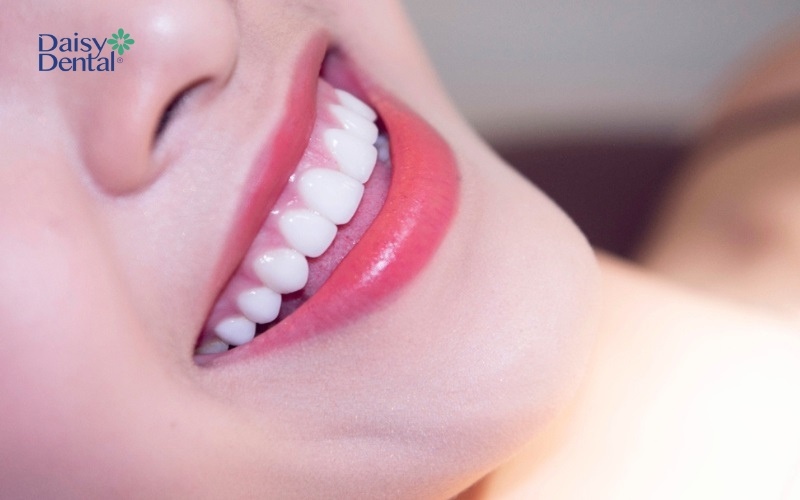 Dán sứ Veneer có thể áp dụng cho các trường hợp răng bị mẻ nhẹ