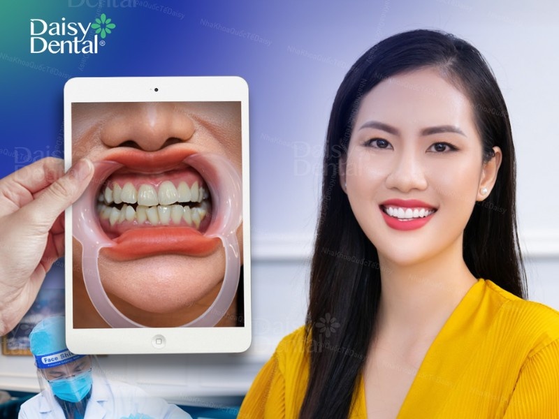 Hình ảnh răng MC Phương Thu trước và sau khi dán sứ Veneer tại Nha khoa DAISY