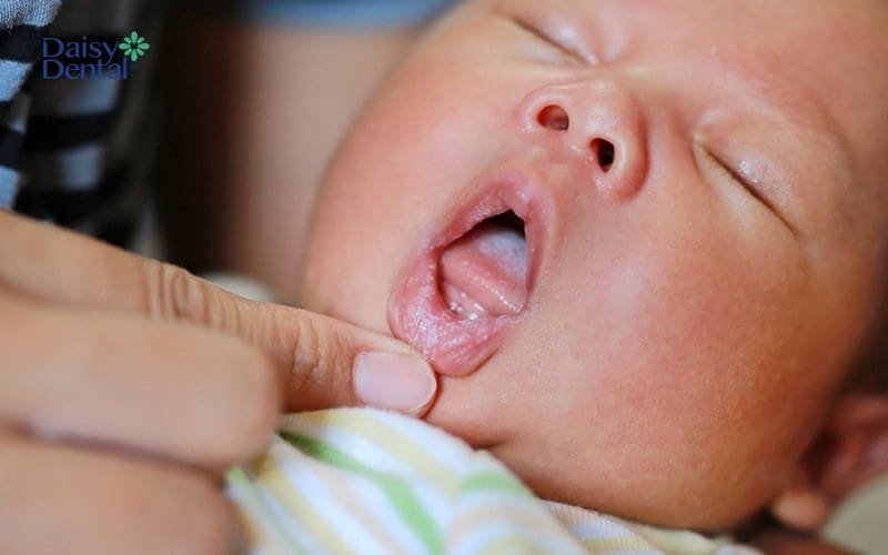 Mảng bám trắng trong miệng trẻ sơ sinh