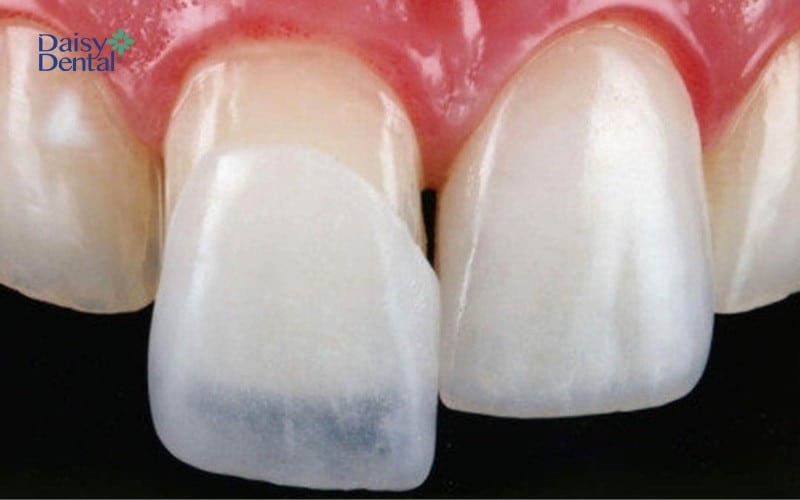 Miếng dán răng thưa được dùng trong các trường hợp răng bị thưa nhẹ