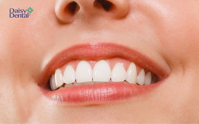 Miếng dán răng thưa mang đến hàm răng trắng sáng cho người sở hữu