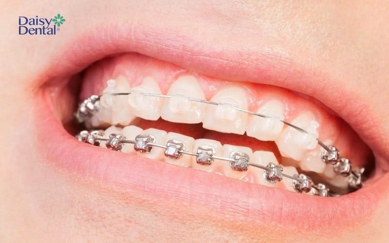 Niềng răng là phương pháp khắc phục tình trạng răng khấp khểnh tối ưu