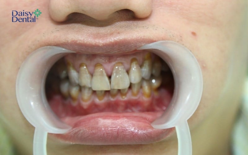 Sử dụng nhiều thuốc kháng sinh có thể khiến răng bị vàng bên trong