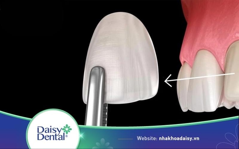 dán răng sứ có tháo ra được không