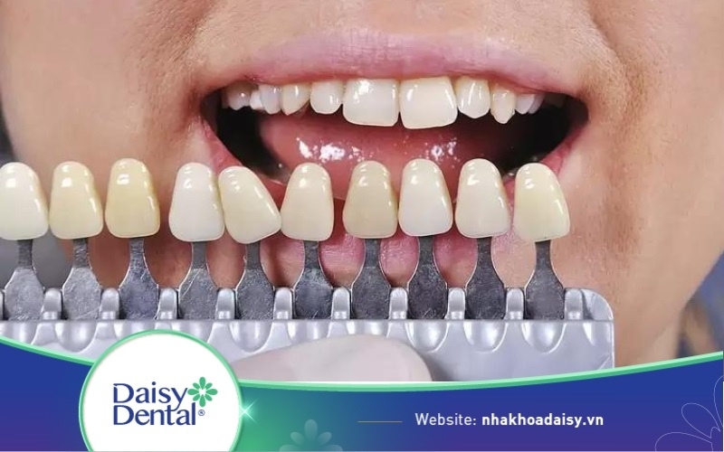 dán sứ răng khấp khểnh
