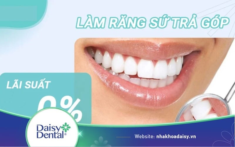 Dán sứ Veneer trả góp