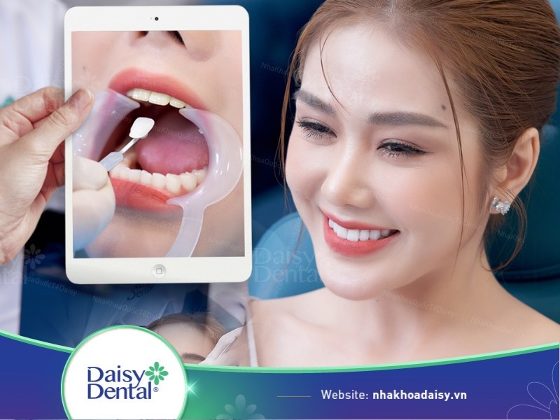 hình ảnh dán sứ veneer