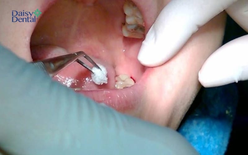 Bác sĩ sẽ xử lý vị trí xương ổ răng bị viêm và cho người bệnh cắn băng gạc