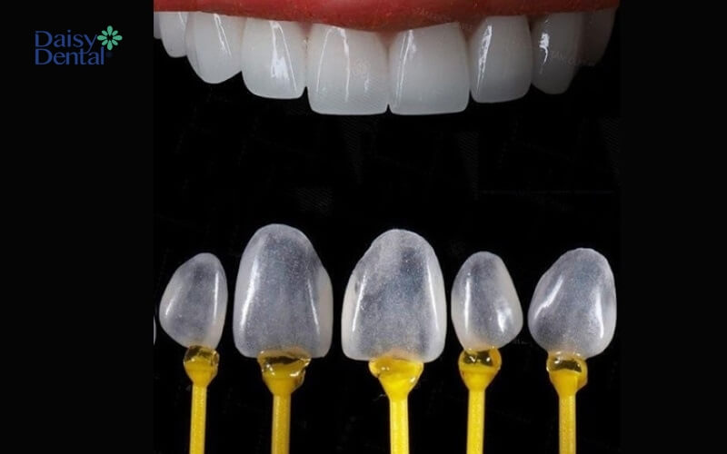 Dán răng sứ là kỹ thuật phục hình răng hiện đại