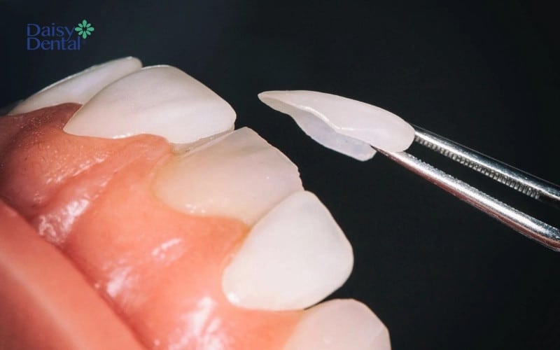 Dán sứ Veneer là kỹ thuật gắn mặt sứ cực mỏng lên trên bề mặt răng