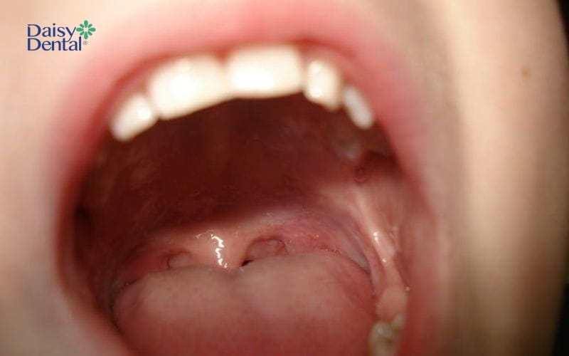 Hình ảnh vòm họng không bị viêm, khỏe mạnh bình thường