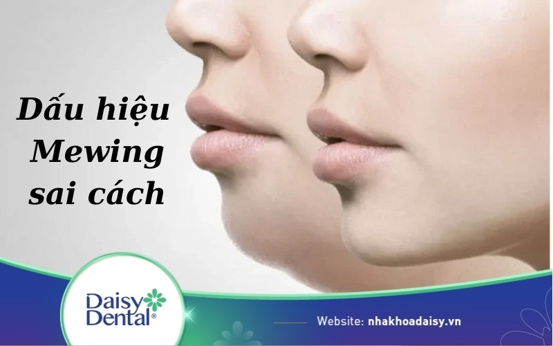 Dấu hiệu tập Mewing sai cách là gì? Lưu ý khi tập Mewing