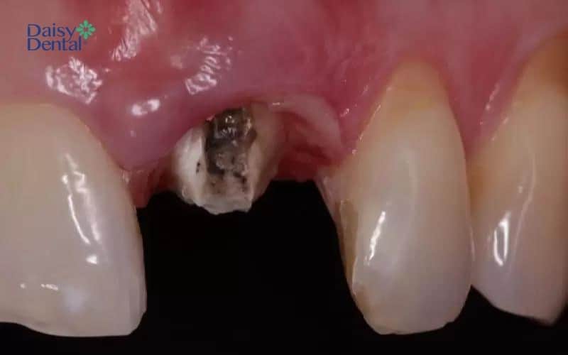 Trụ răng bị gãy khiến răng Implant lung lay
