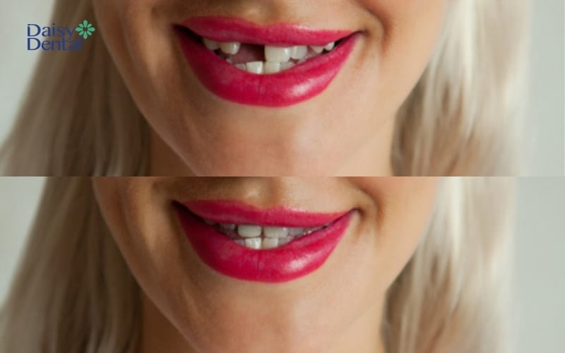 Người bị mất răng có thể sử dụng trụ Implant Thụy Sĩ