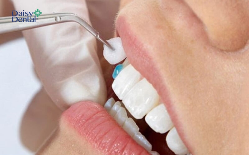 Vật liệu kết dính tốt là yếu tố giúp kéo dài thời gian dán răng sứ được bao lâu
