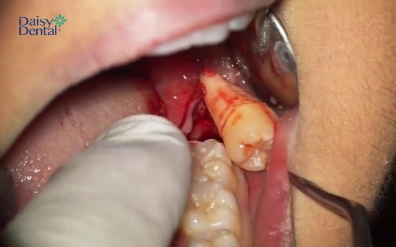 Vị trí răng vừa nhổ bị chảy máu là biểu hiện bình thường