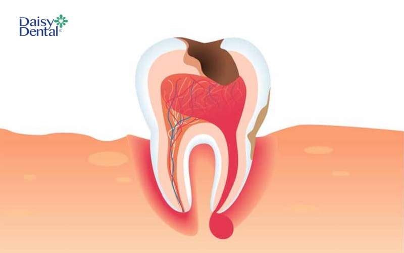 Bệnh lý áp xe răng sẽ gây nổi cục ở lợi, thường gặp nhất là mụn mủ