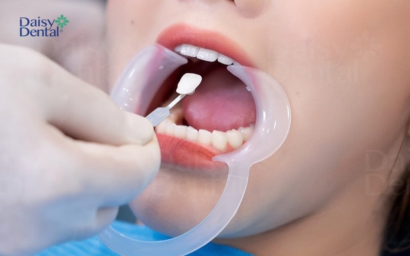 Bọc răng sứ là phương pháp khắc phục tình trạng răng có đốm trắng nhanh chóng