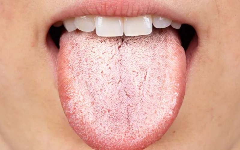 Nấm miệng là bệnh lý xuất hiện do nấm Candida Albicans