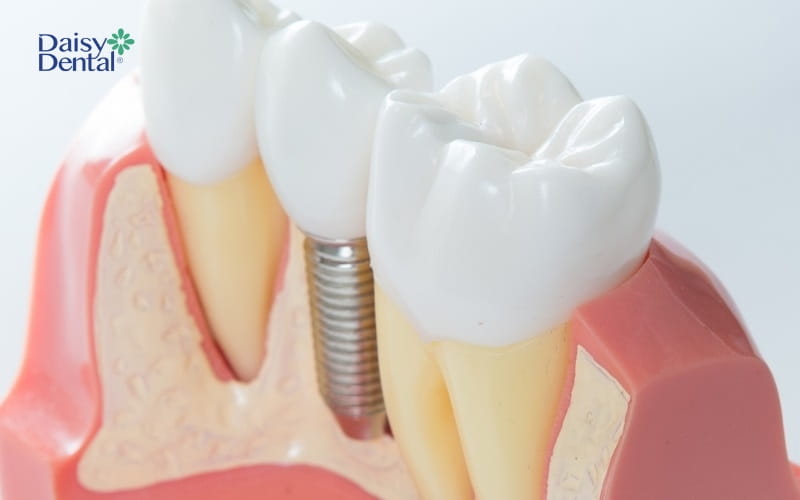 Cấy ghép Implant là giải pháp phục hình răng tối ưu bạn nên lựa chọn