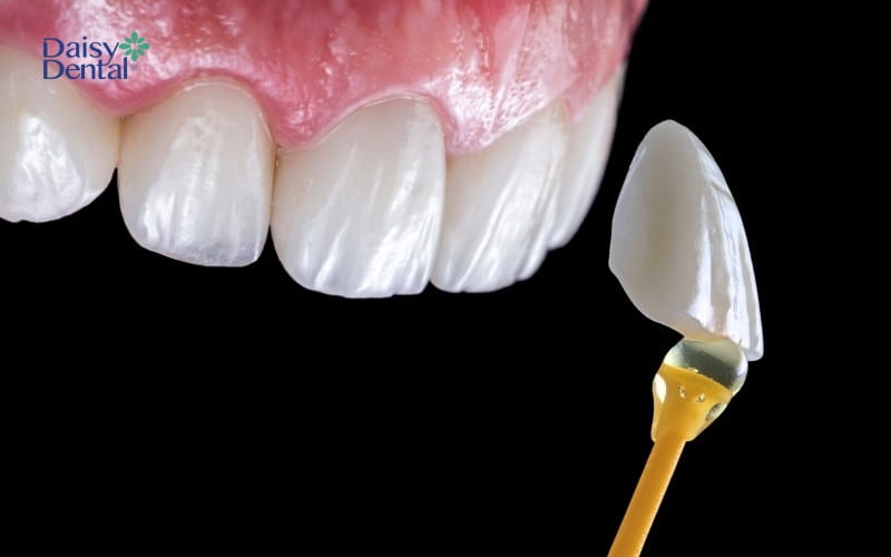 Dán sứ Veneer là giải pháp phục hình răng bị mẻ sở hữu nhiều ưu điểm nổi bật