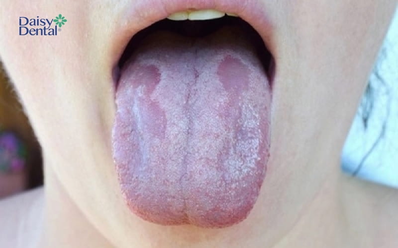 Lưỡi màu tím là dấu hiệu cơ thể có nguy cơ bị bệnh tim
