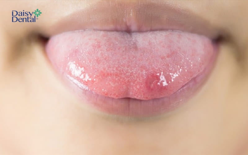 Hình ảnh lưỡi bị sưng đỏ có thể là dấu hiệu cho thấy cơ thể mắc ung thư