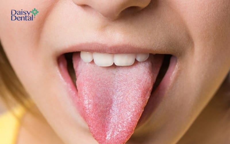 Lưỡi bình thường có các u nhú được phân bố đều nhau