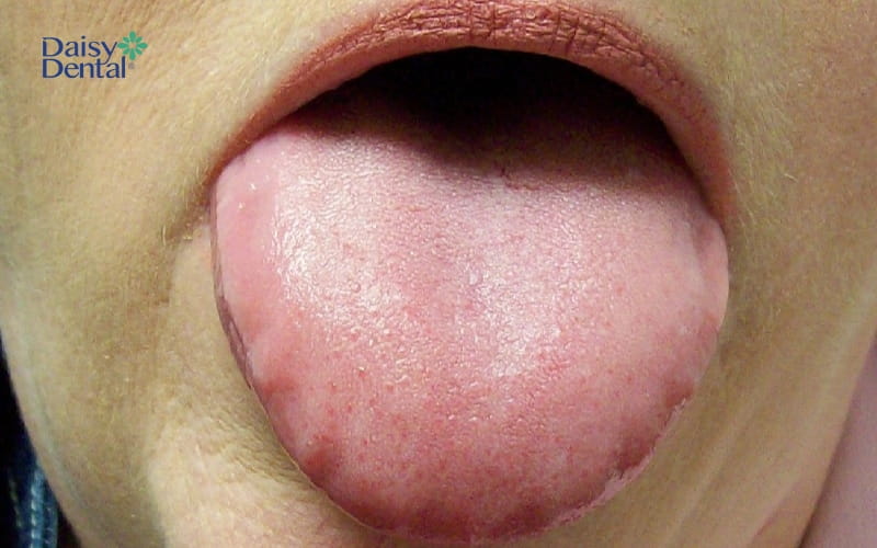 Lưỡi có màu hồng nhạt là dấu hiệu sức khỏe của bạn tốt